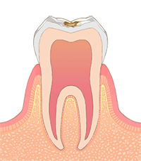 Ｃ１（エナメル質の虫歯）