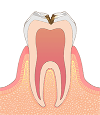 Ｃ２（象牙質の虫歯）