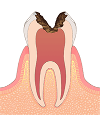 Ｃ３（歯髄まで侵された虫歯）