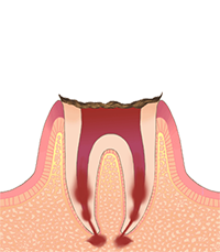 Ｃ４（末期の虫歯）