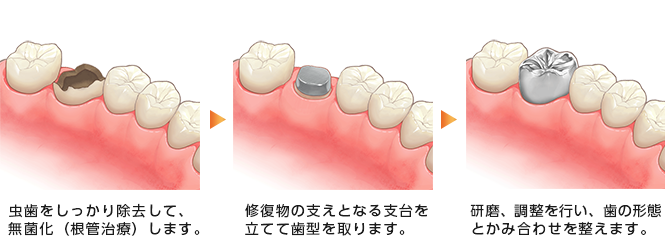 クラウン修復法の流れ