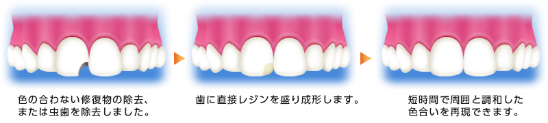 ダイレクトボンディング治療の流れ