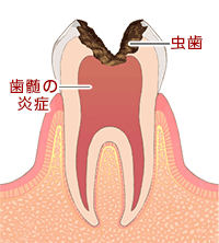 歯髄炎