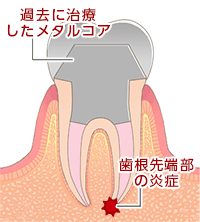 根尖性歯周炎