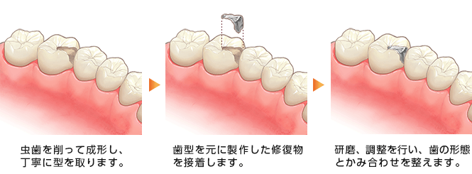 インレー修復法の流れ