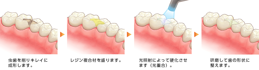 コンポジットレジン治療の流れ