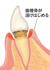 軽度歯周炎