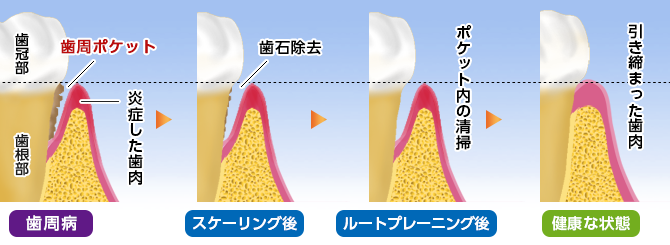 ルートプレーニング（歯根面クリーニング）