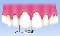 レジンで固定