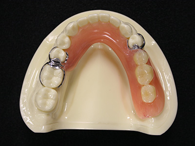 部分入れ歯と総入れ歯