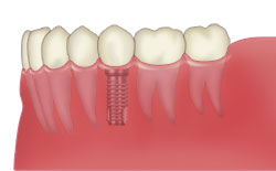 インプラント治療