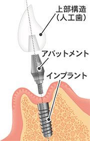 ８０歳で２０本の歯を残す